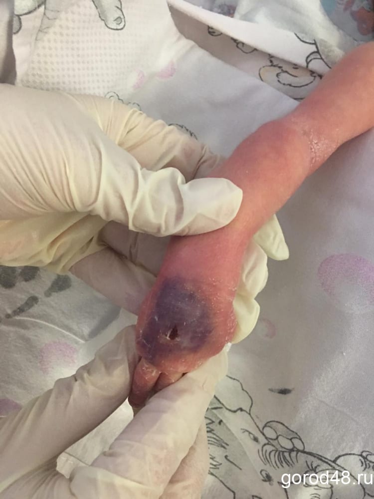 В Липецке новорожденной девочке чуть не ампутировали руку из-за катетера