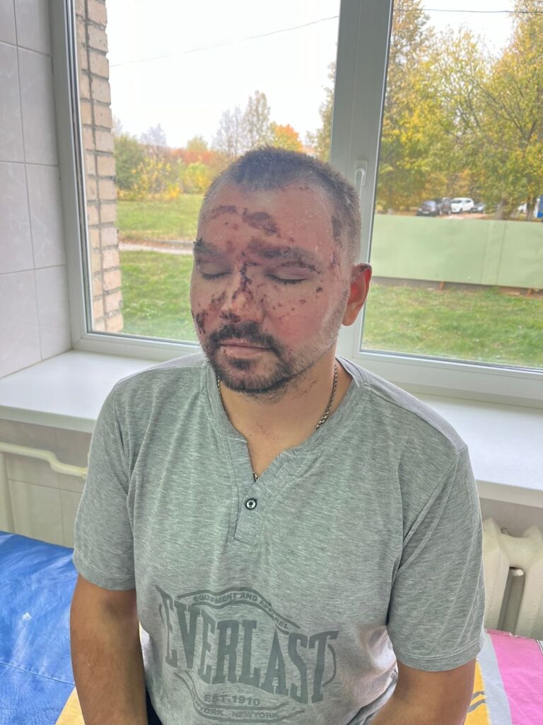 Рязанские врачи пересадили кожу пациенту, который получил серьезные ожоги лица и ног Мужчина получил ожоги во время тушения пожара.